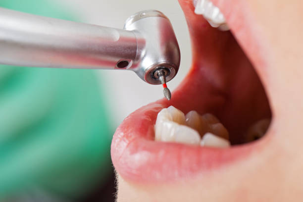 Best Emergency Wisdom Teeth Removal in Pine Ridge, SD